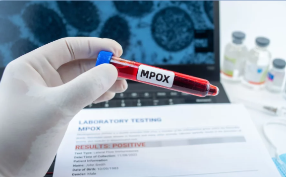 SANTÉ : UN CAS DE MPOX DÉTECTÉ À DAKAR (MSAS)