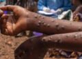 Épidémie : Progression contenue de la Fièvre de la Vallée du Rift et du Mpox