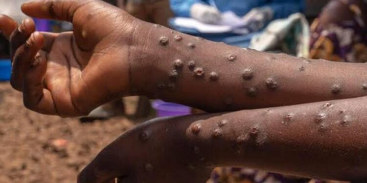 Épidémie : Progression contenue de la Fièvre de la Vallée du Rift et du Mpox