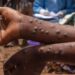Épidémie : Progression contenue de la Fièvre de la Vallée du Rift et du Mpox