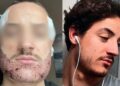 Turquie : un étudiant français se suicide après une greffe de barbe ratée