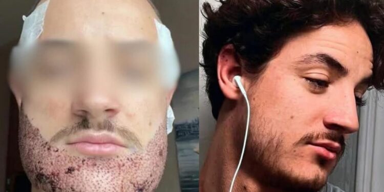 Turquie : un étudiant français se suicide après une greffe de barbe ratée