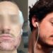 Turquie : un étudiant français se suicide après une greffe de barbe ratée